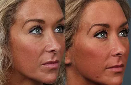 Woman before and after cosmetic or plastic procedure, anti-age therapy.