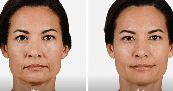 Wrinkles on the face before and after the procedure.