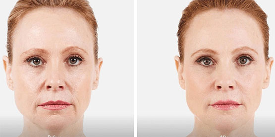 Woman face wrinkles before and after treatment.