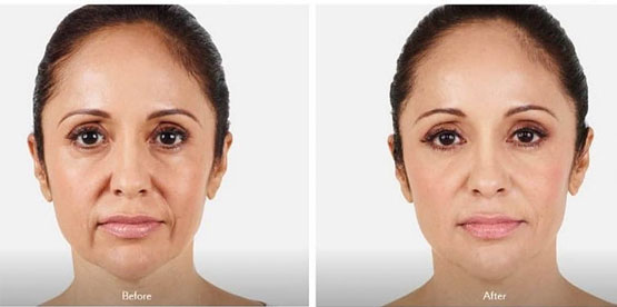 Botox before and after result.