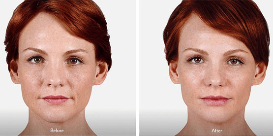 A patient with and without aging signs.