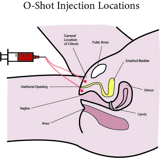 O-Shot Injection Locations Chart.