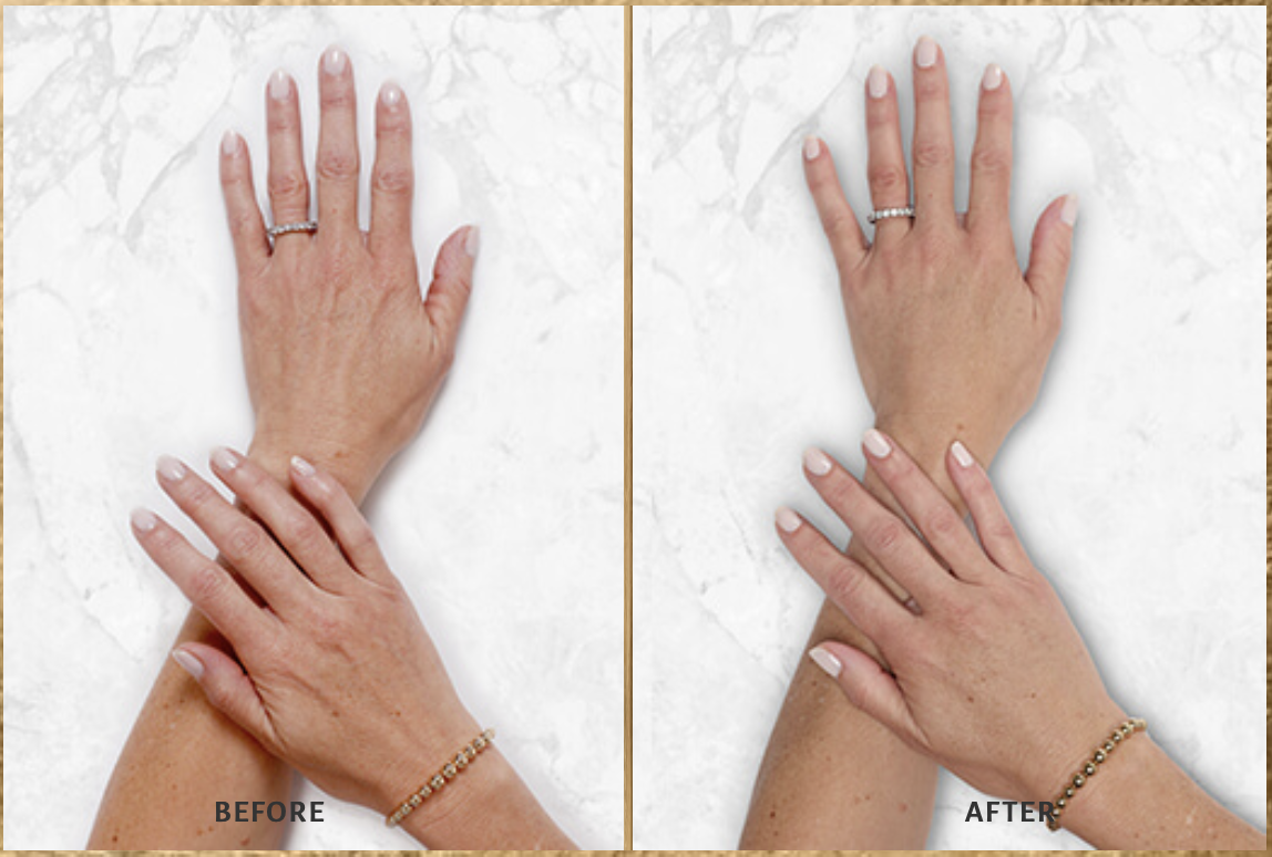restylane before and after