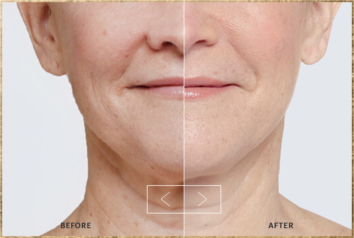 restylane near me