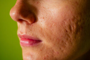 acne scar treatments in frederick